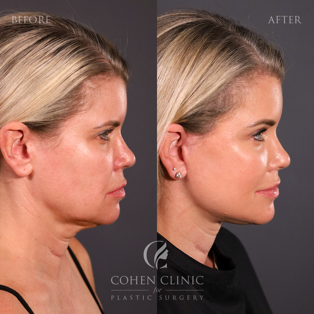 Case 33378 Marge Image