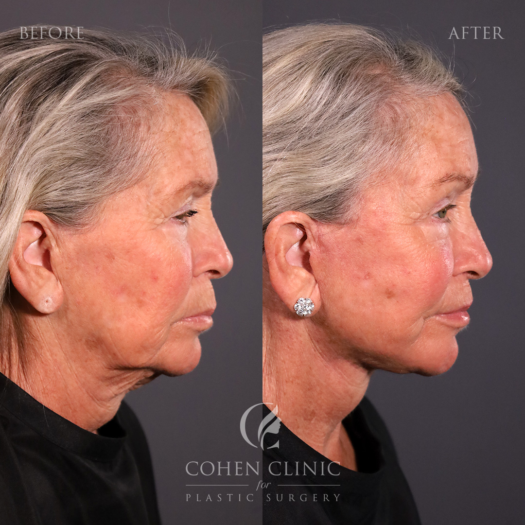 Case 11255 Marge Image