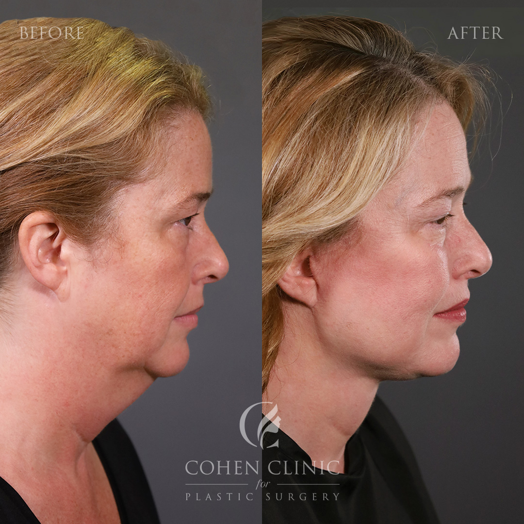 Case 18887 Marge Image