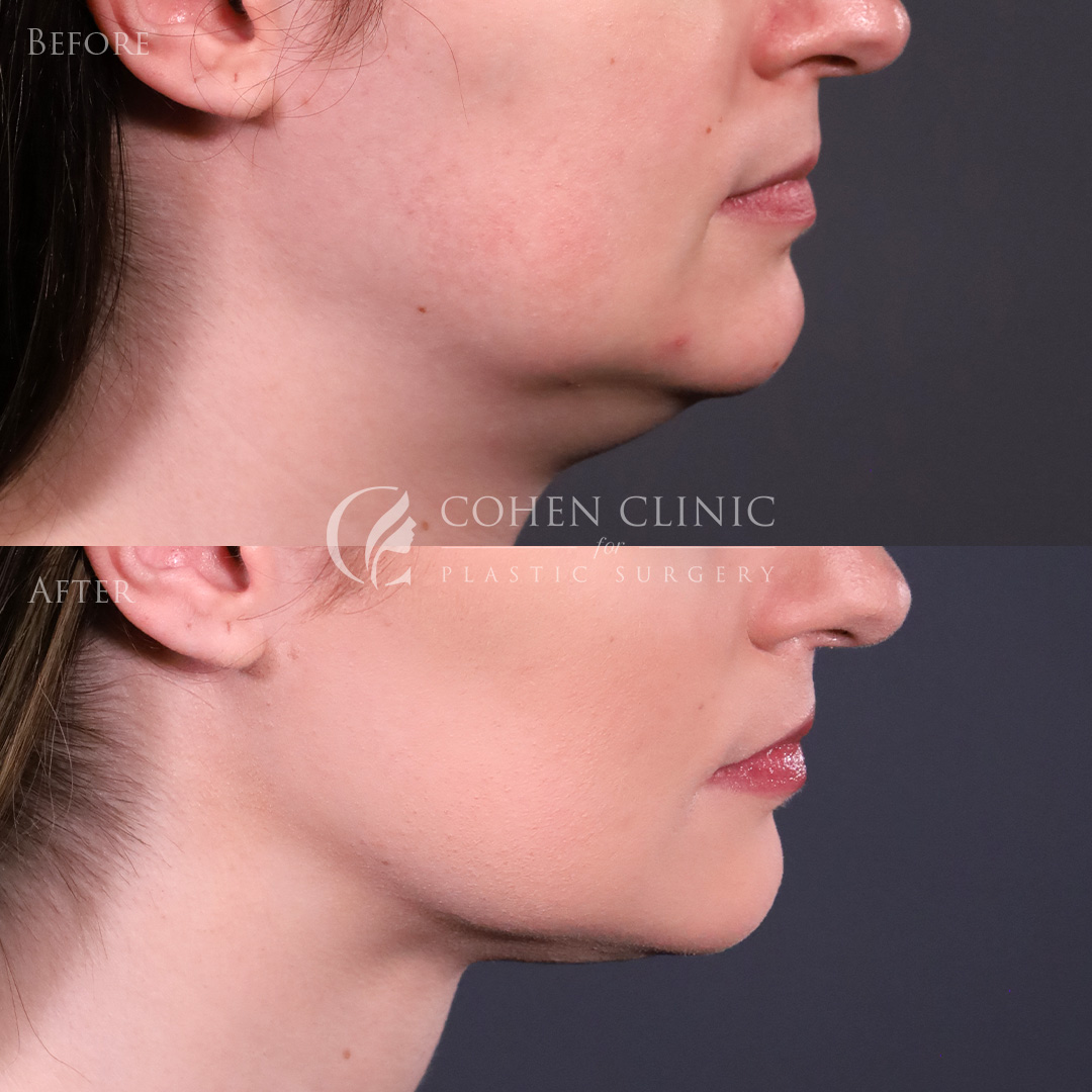 Case 98004 Marge Image