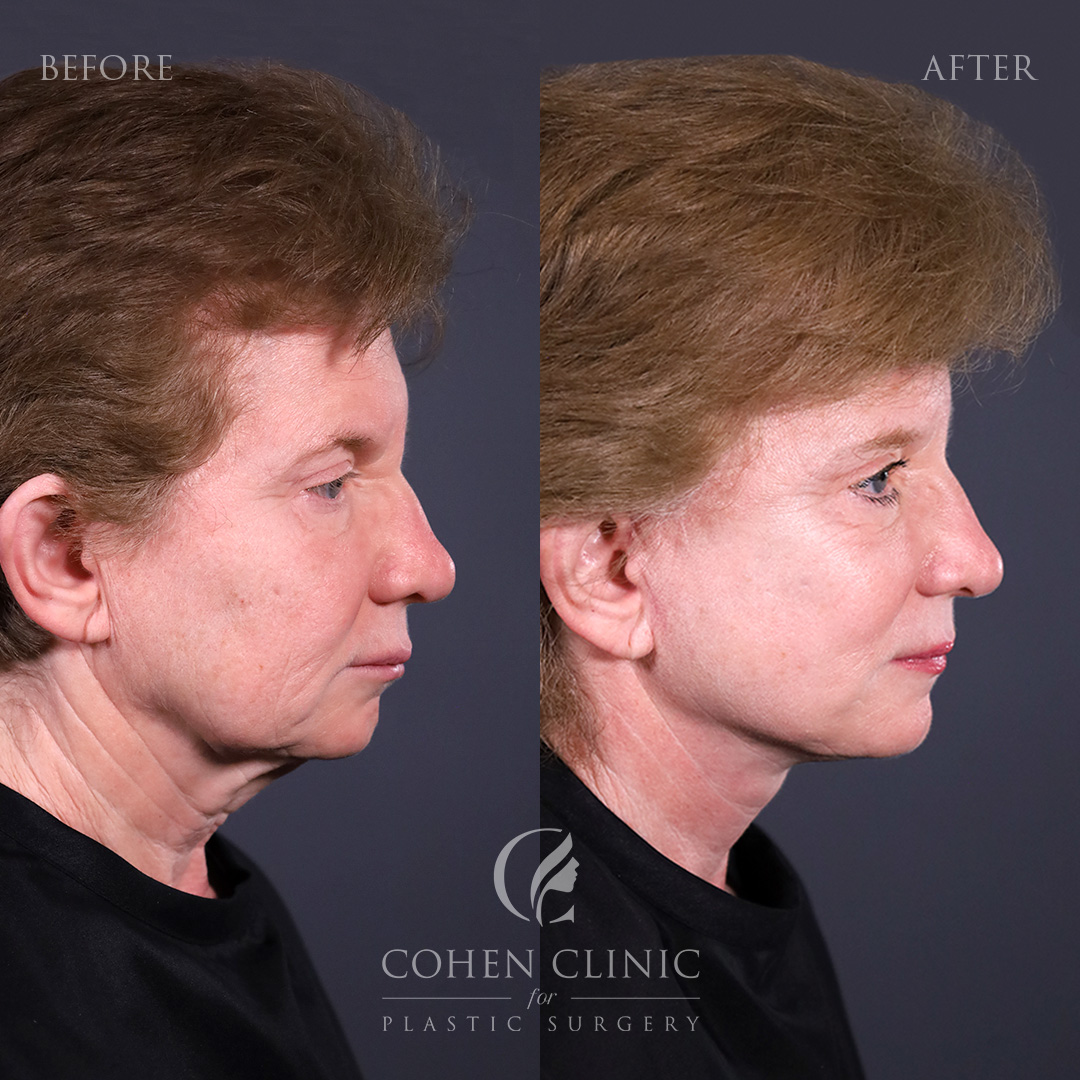 Case 23488 Marge Image