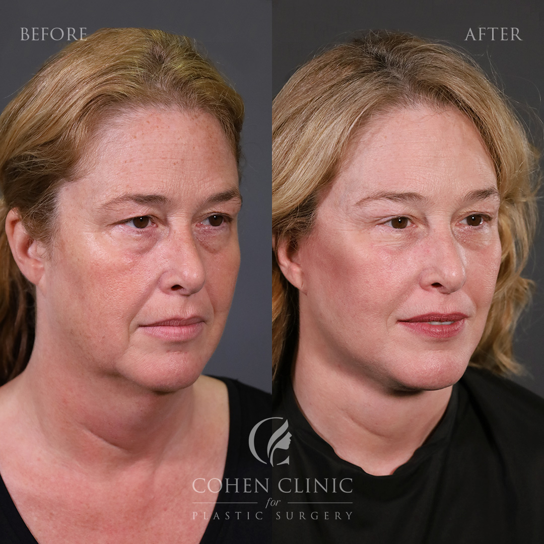 Case 18887 Marge Image