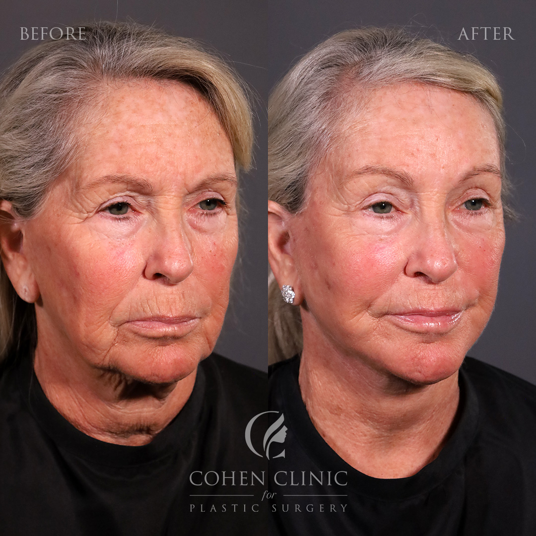 Case 11255 Marge Image