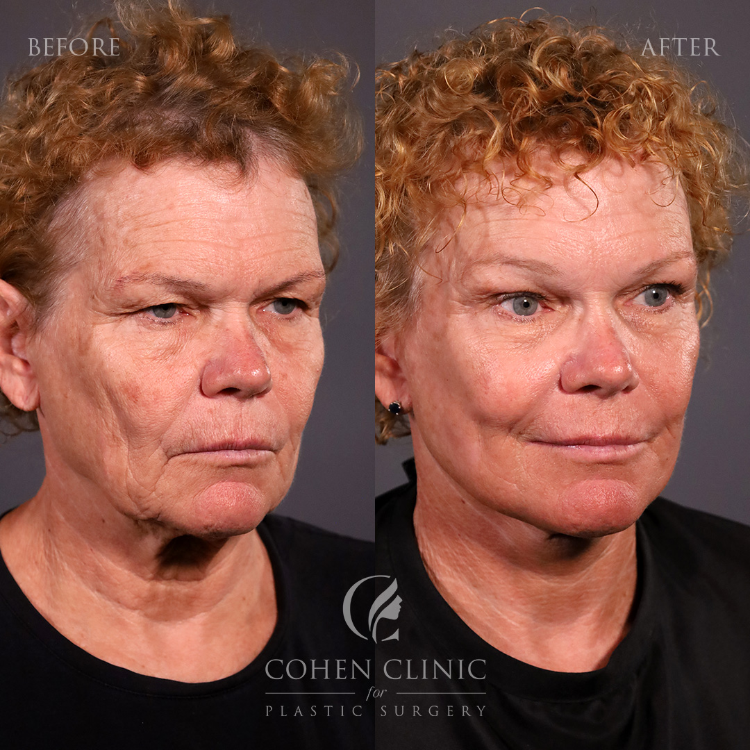 Case 89455 Marge Image