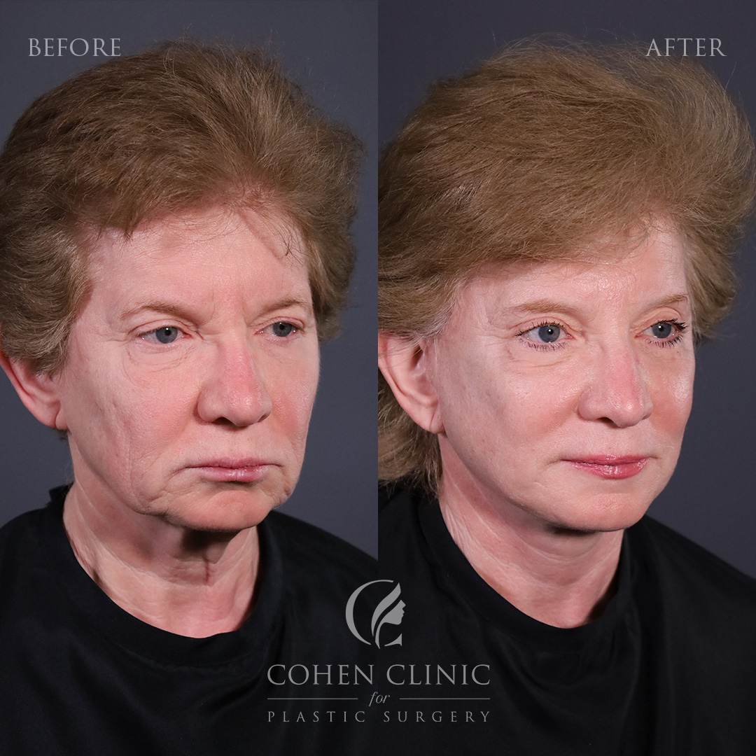 Case 23488 Marge Image