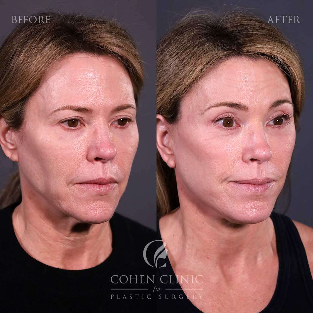 Case 23886 Marge Image