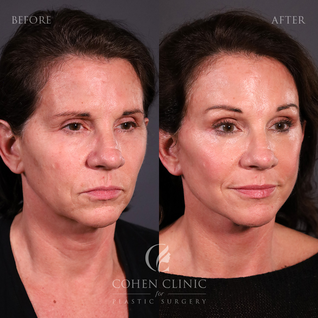 Case 76229 Marge Image