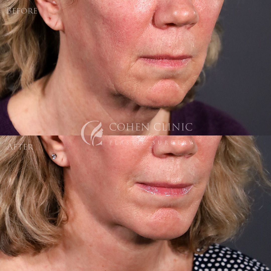 Case 00998 Marge Image