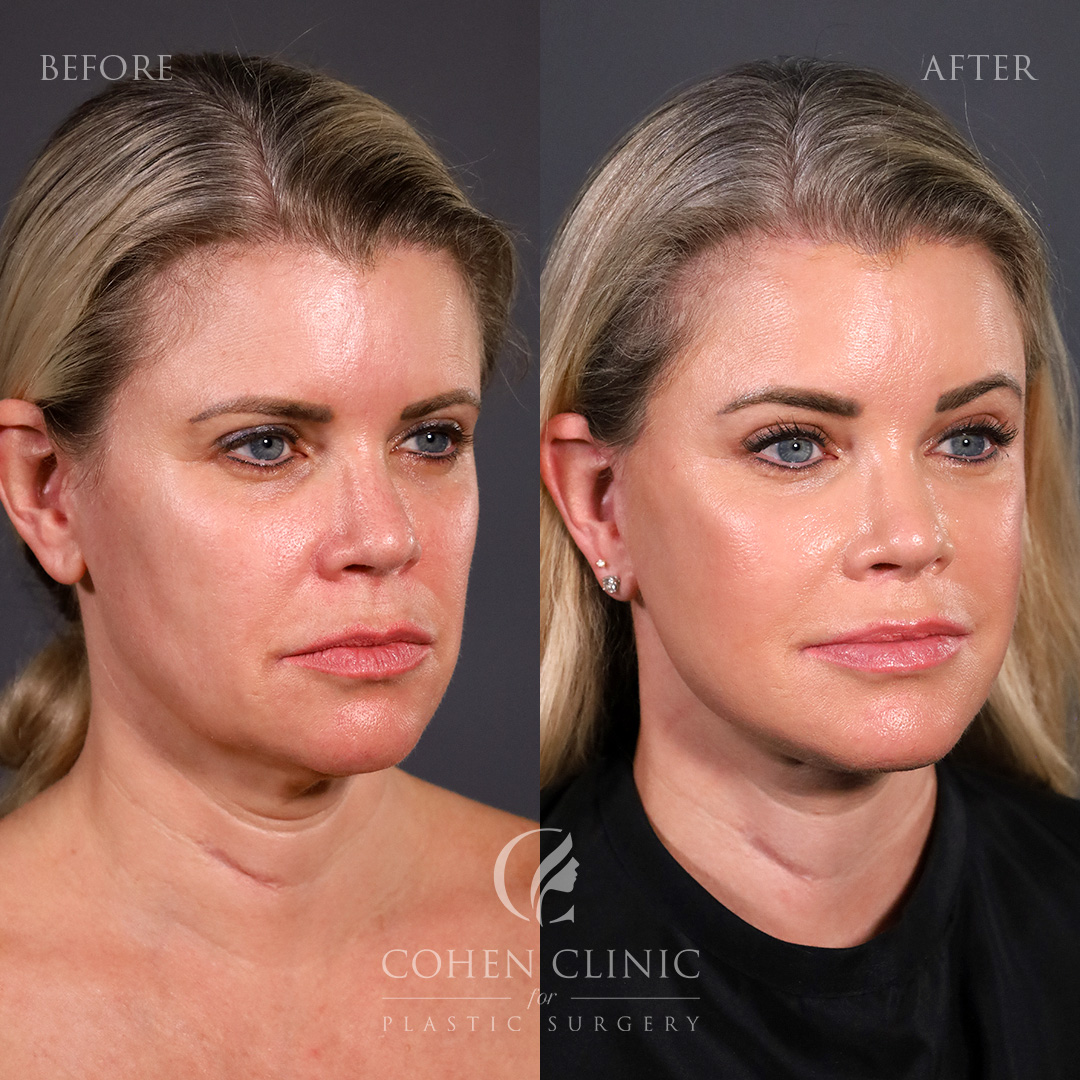 Case 33378 Marge Image