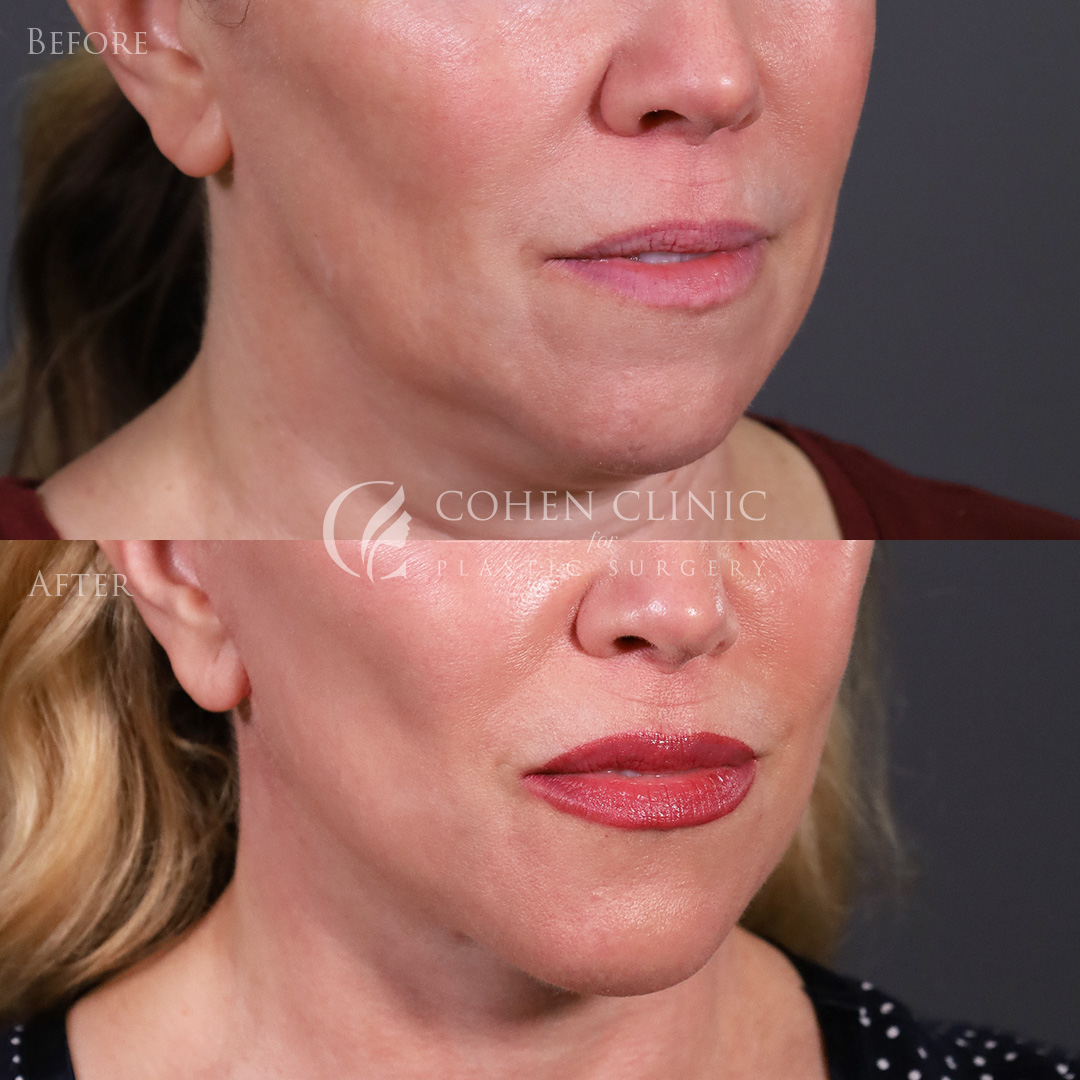 Case 22245 Marge Image