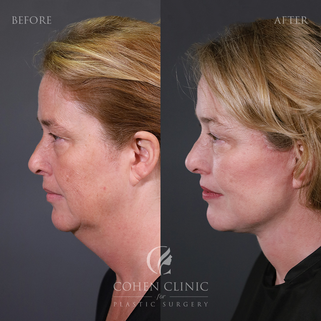 Case 18887 Marge Image