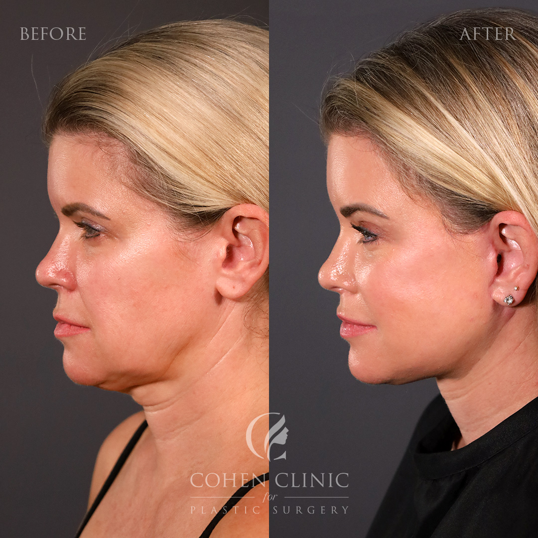 Case 33378 Marge Image