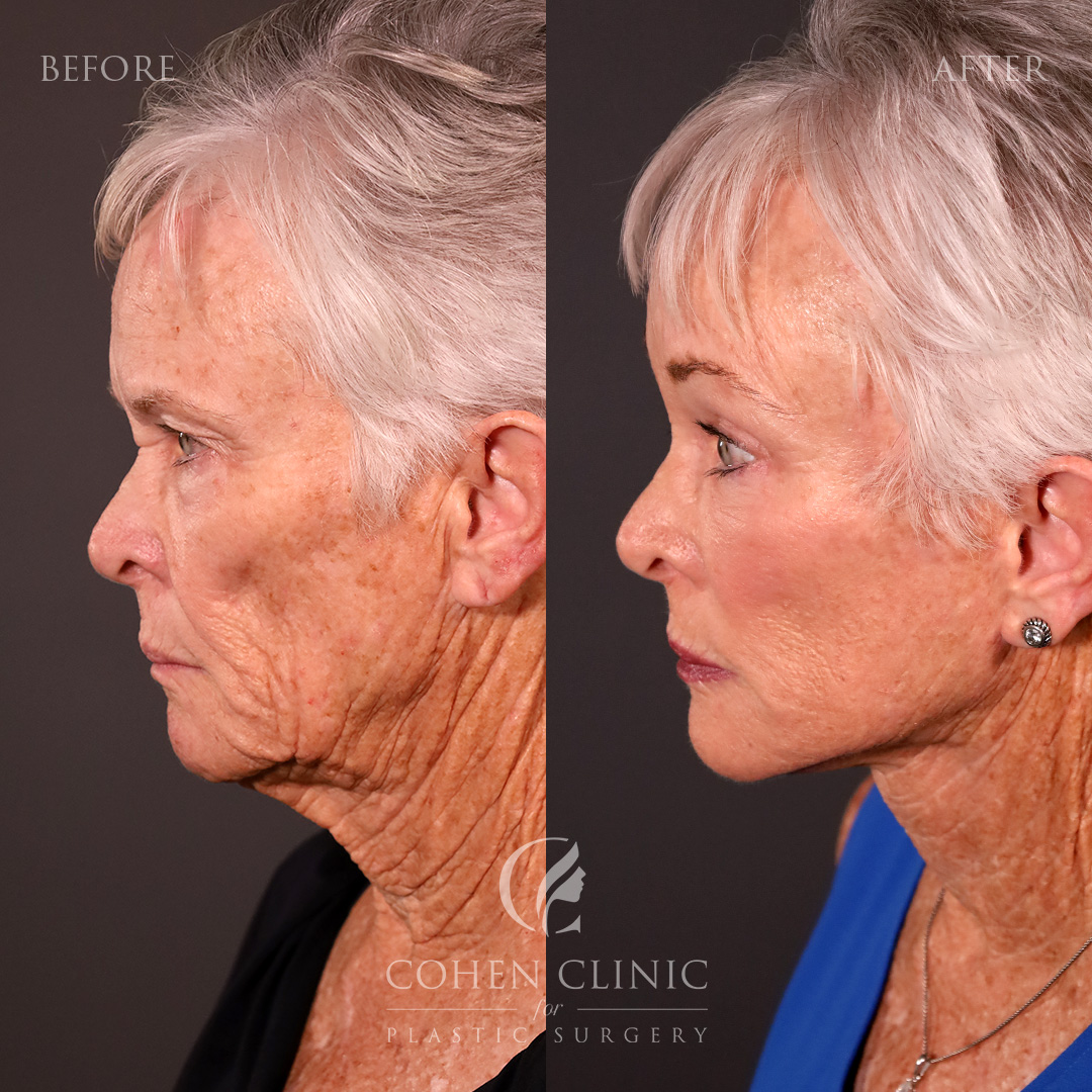 Case 33499 Marge Image