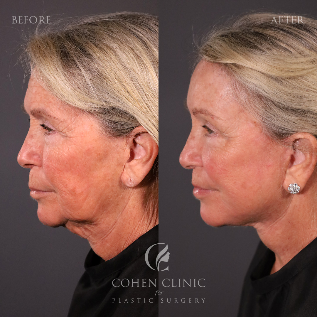 Case 11255 Marge Image