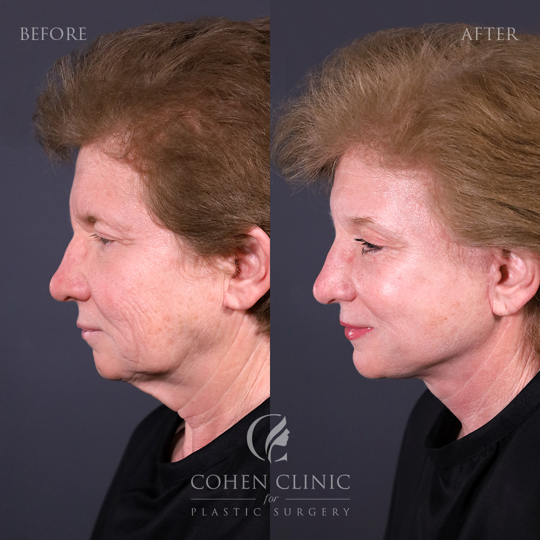 Case 23488 Marge Image