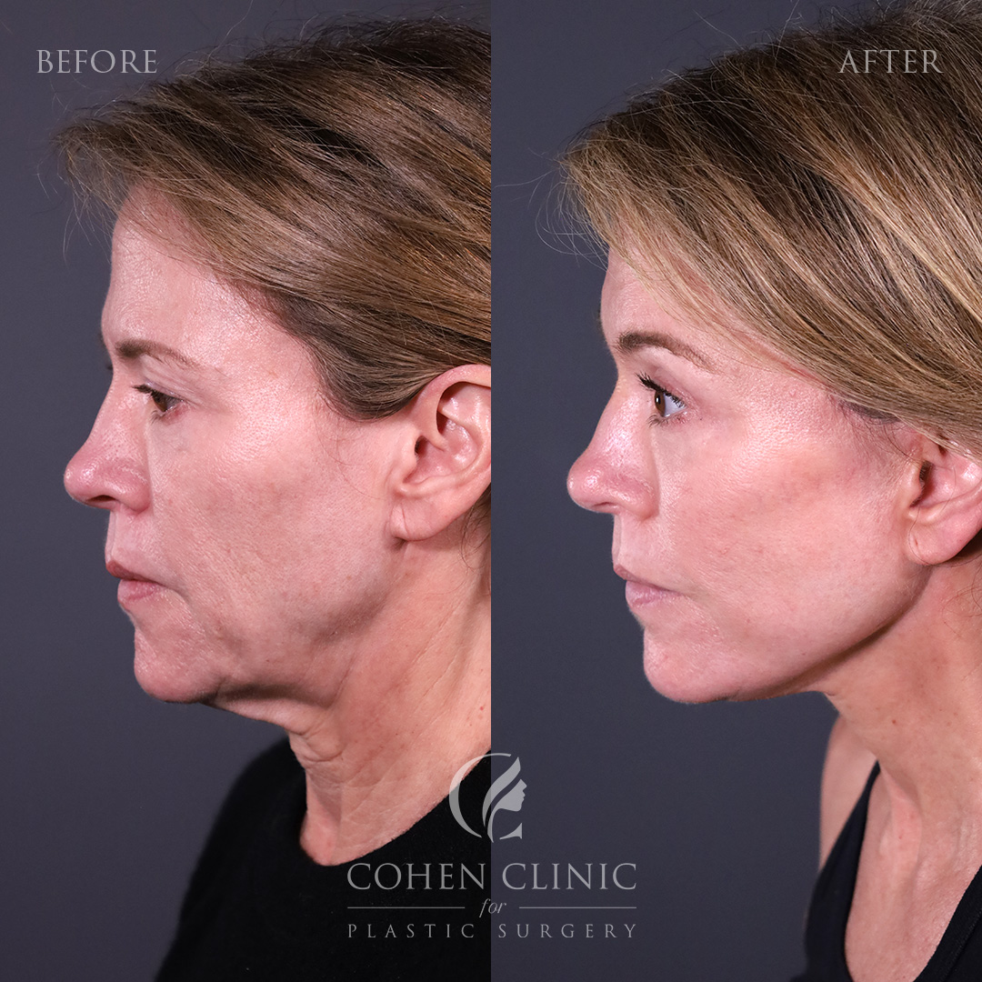 Case 23886 Marge Image