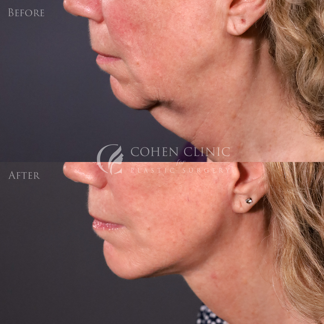 Case 00998 Marge Image