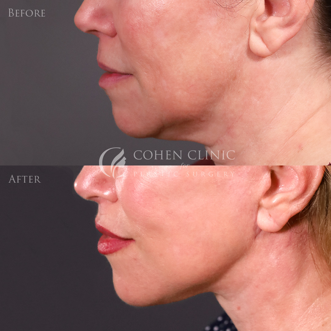 Case 22245 Marge Image