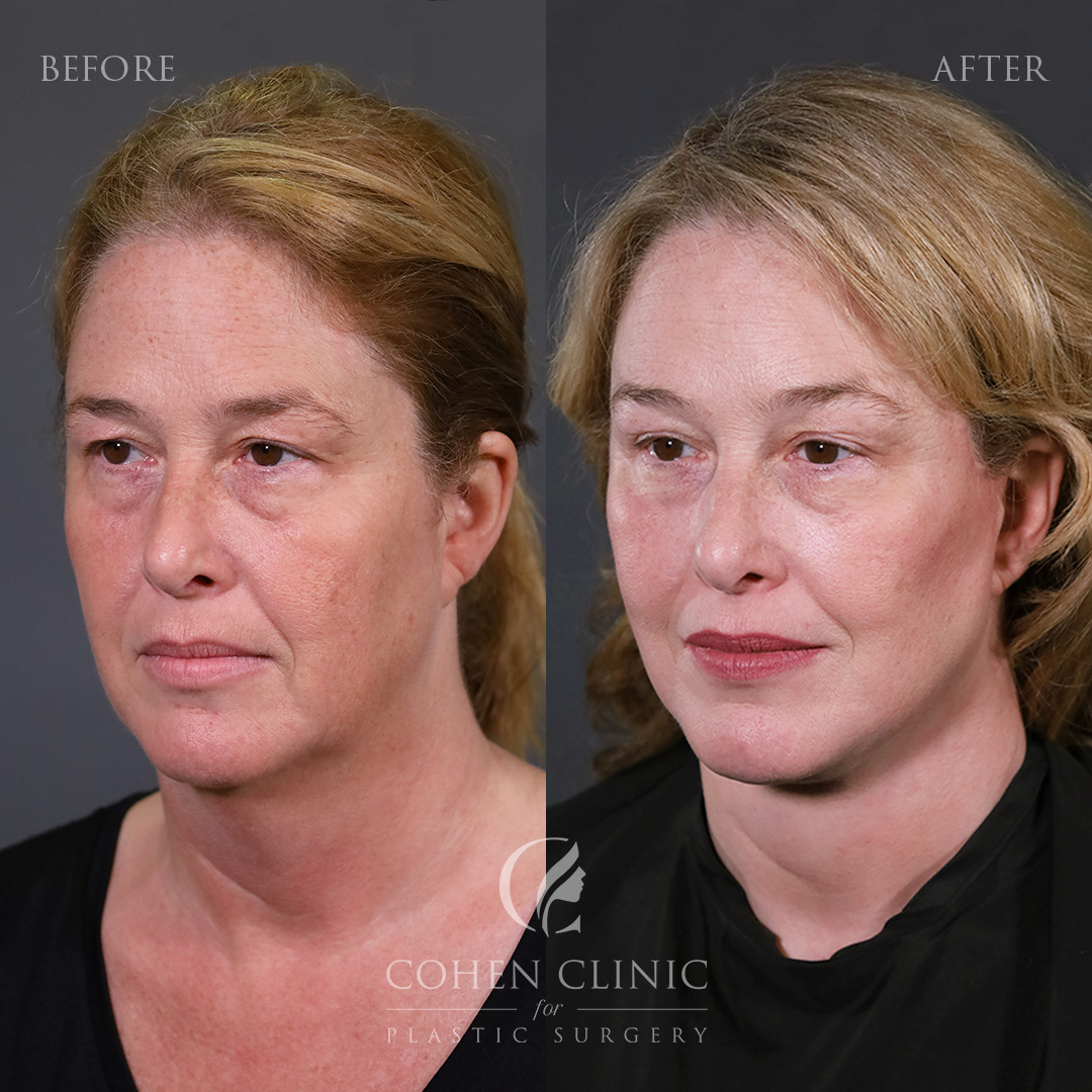 Case 18887 Marge Image