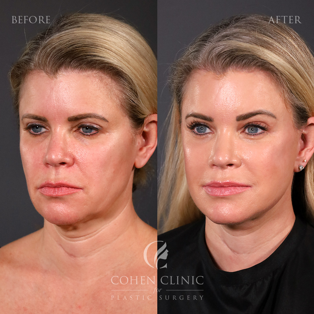 Case 33378 Marge Image