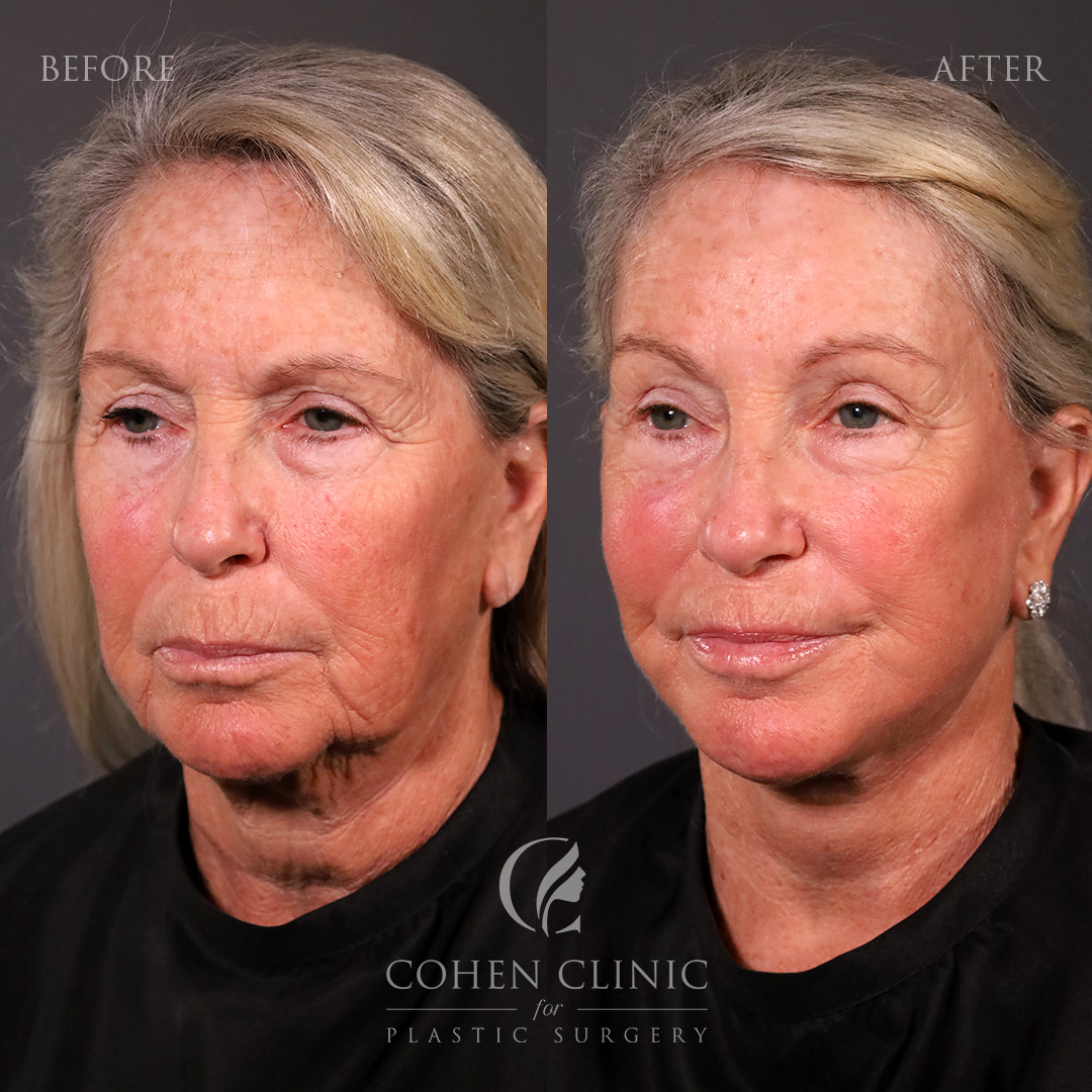 Case 11255 Marge Image