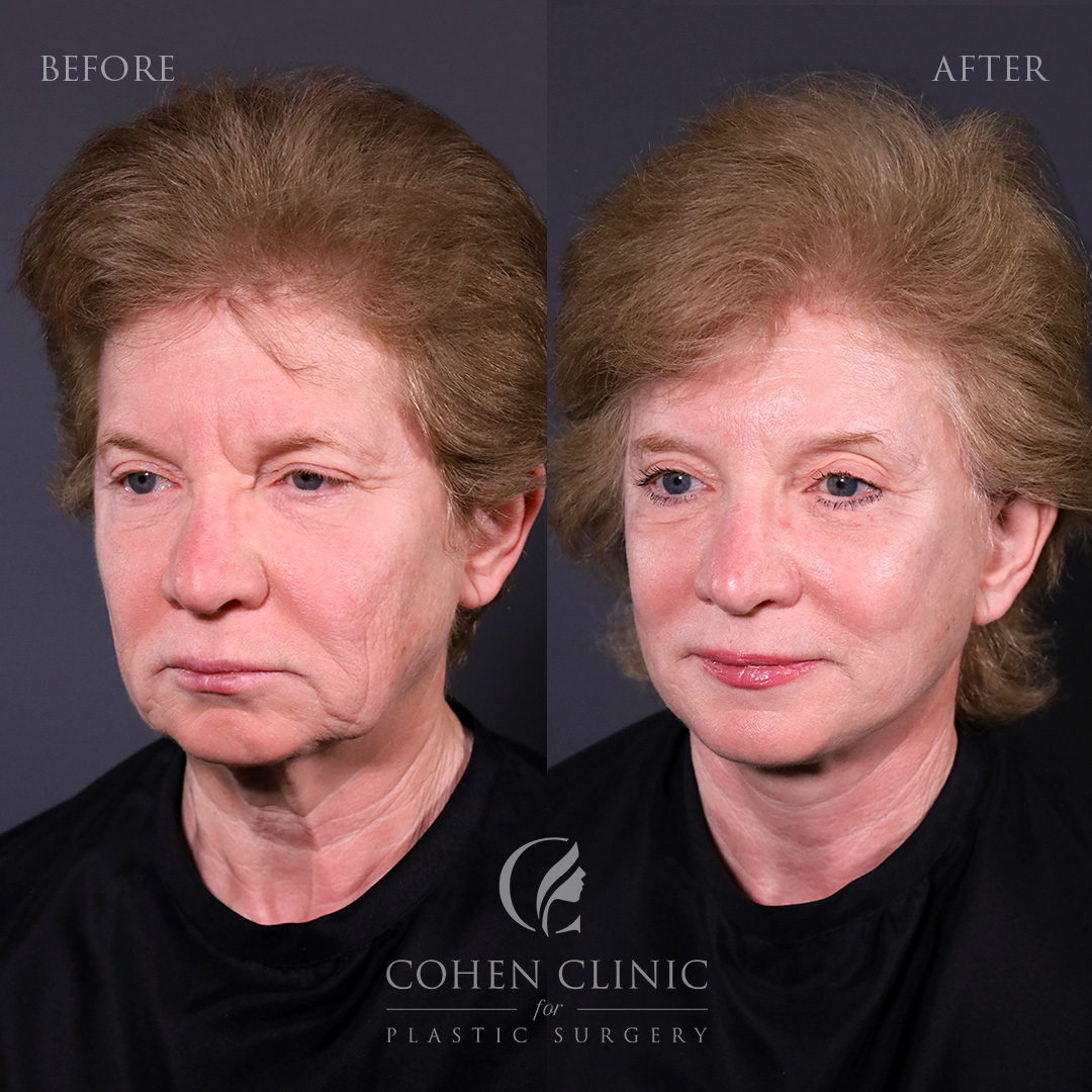 Case 23488 Marge Image