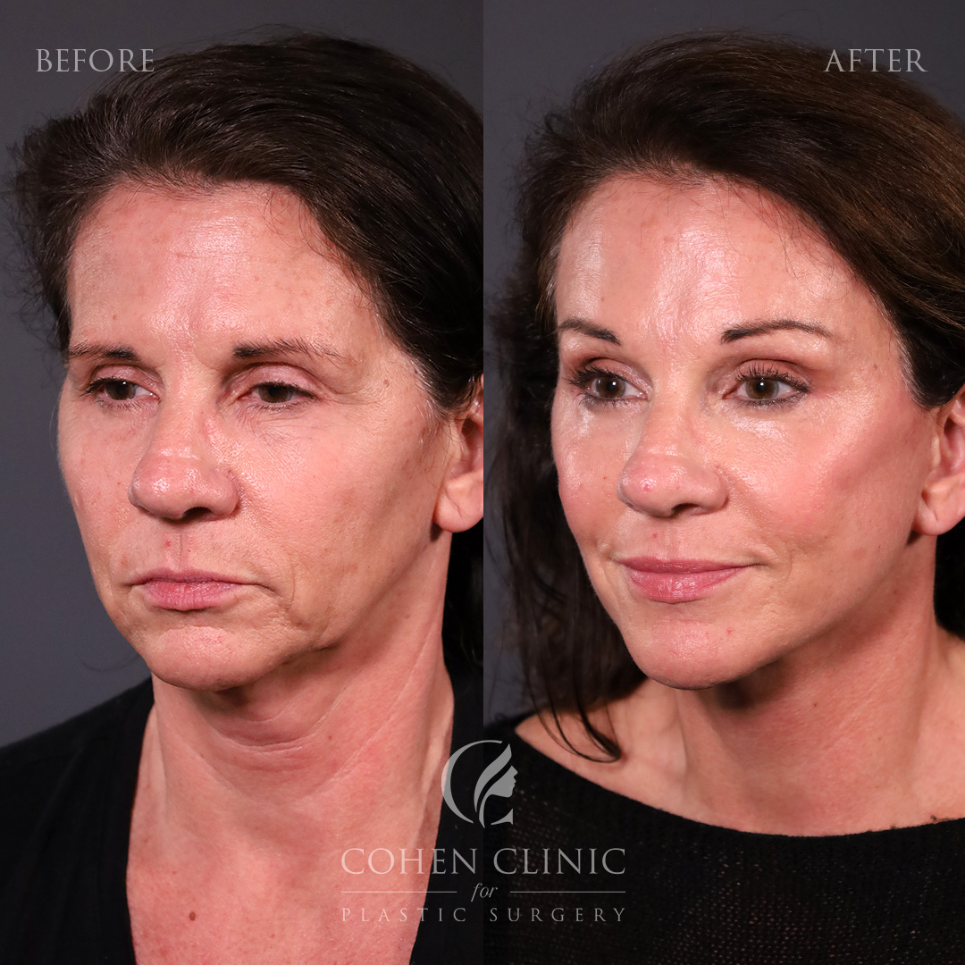 Case 76229 Marge Image