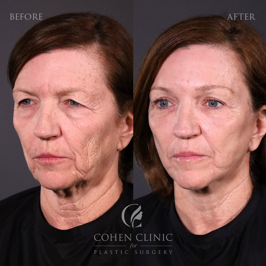 Case 65771 Marge Image