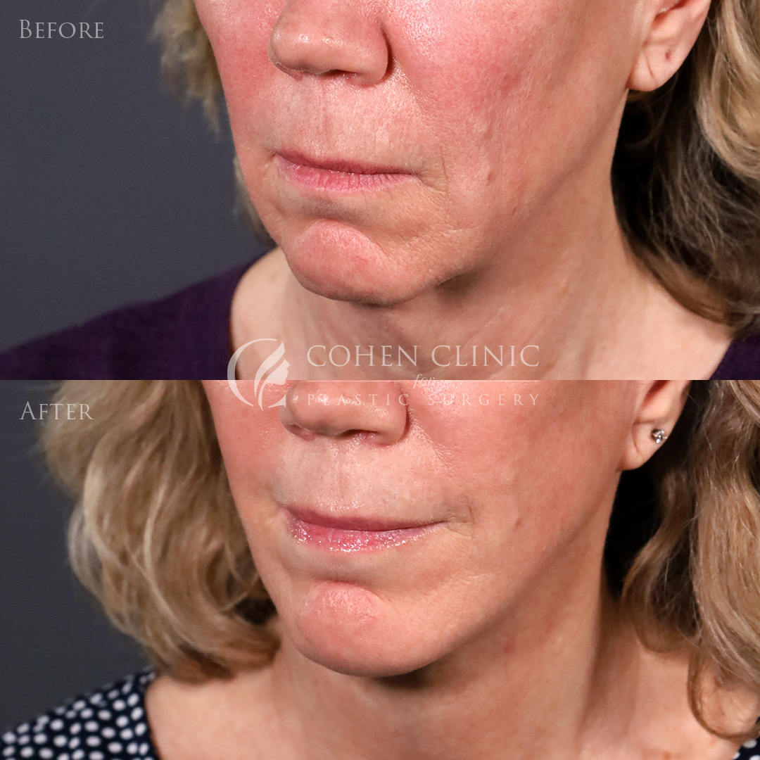 Case 00998 Marge Image