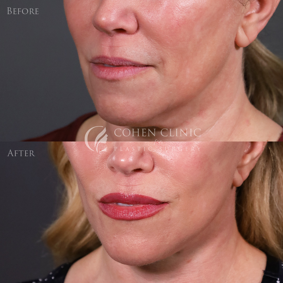 Case 22245 Marge Image