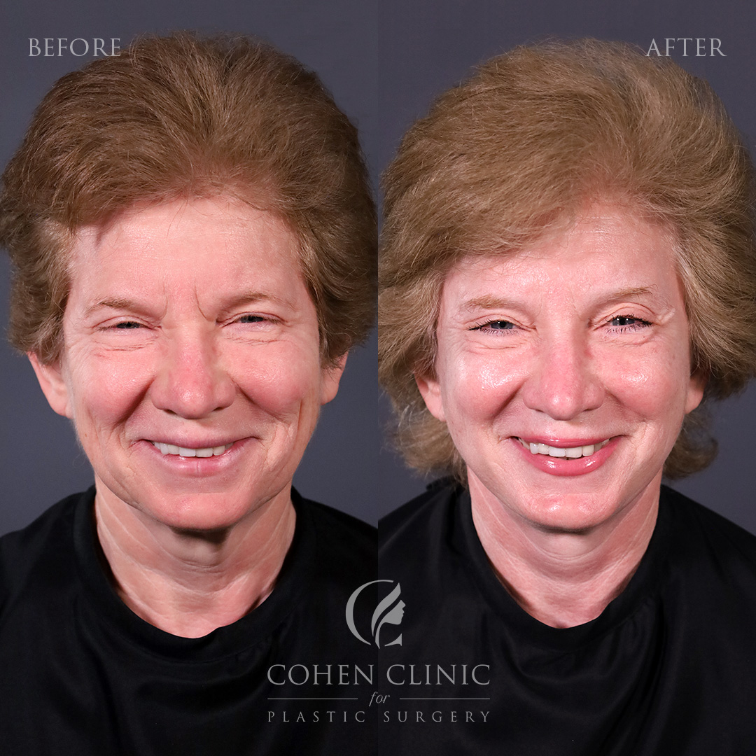 Case 23488 Marge Image