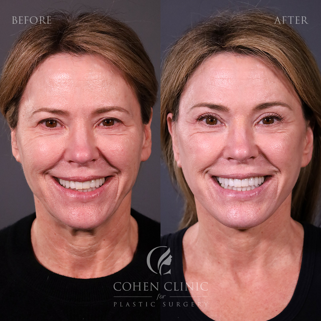 Case 23886 Marge Image