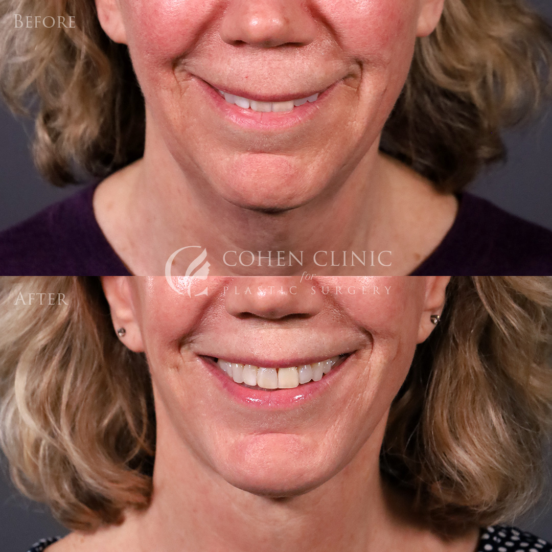 Case 00998 Marge Image