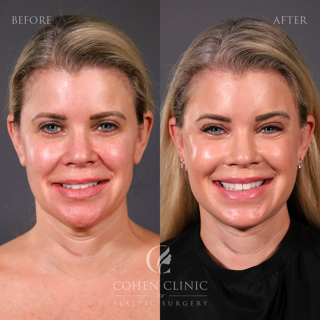 Case 33378 Marge Image