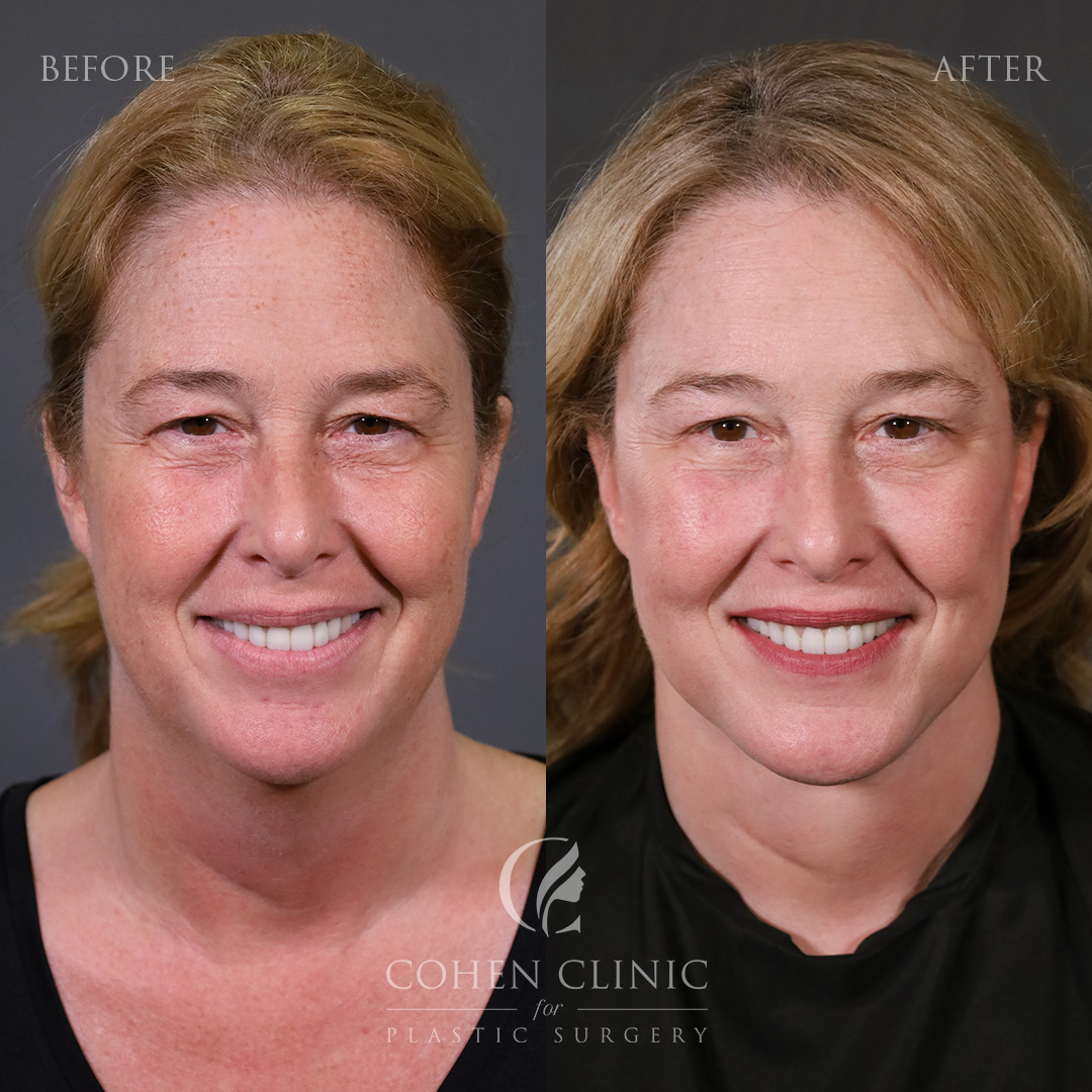 Case 18887 Marge Image