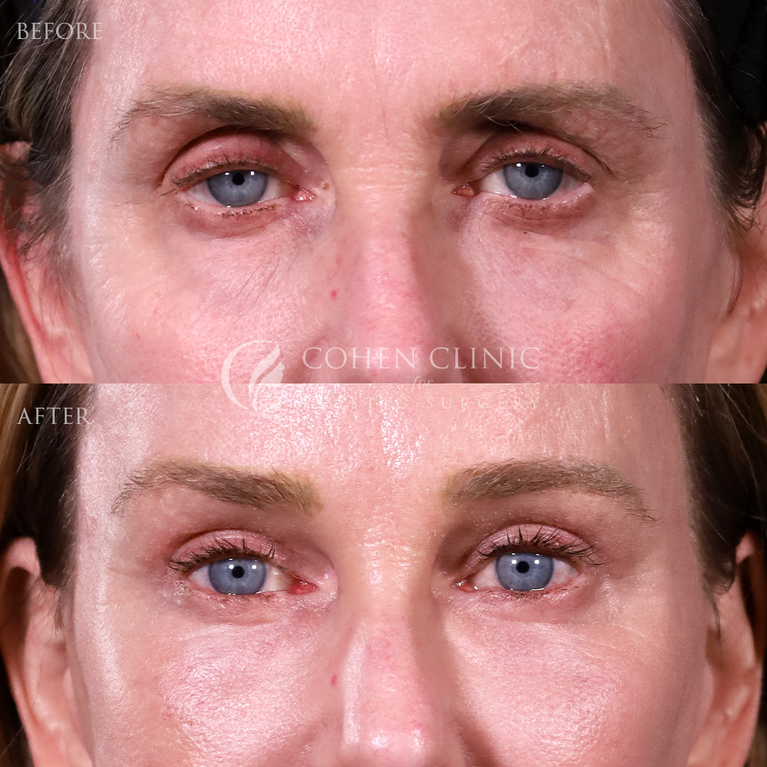 Case 11544 Marge Image