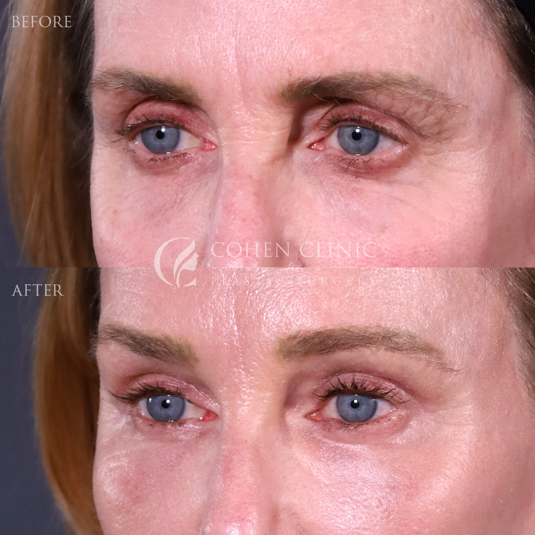 Case 11544 Marge Image