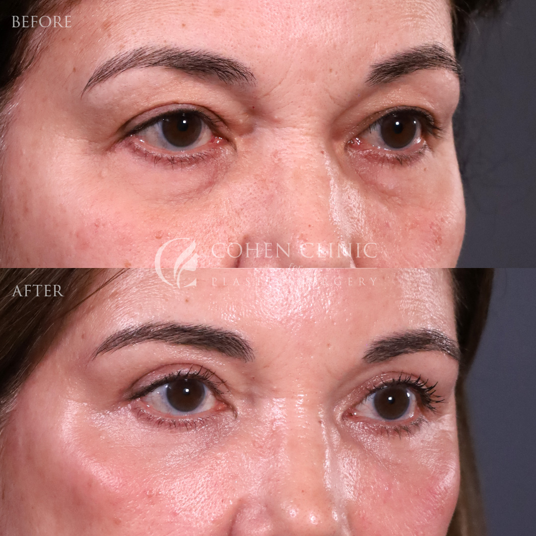 Case 00245 Marge Image