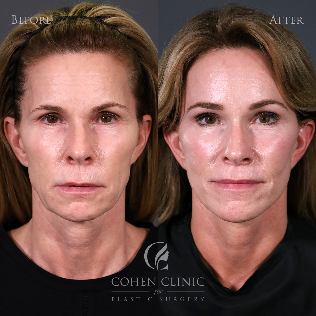 Case 83381 Marge Image