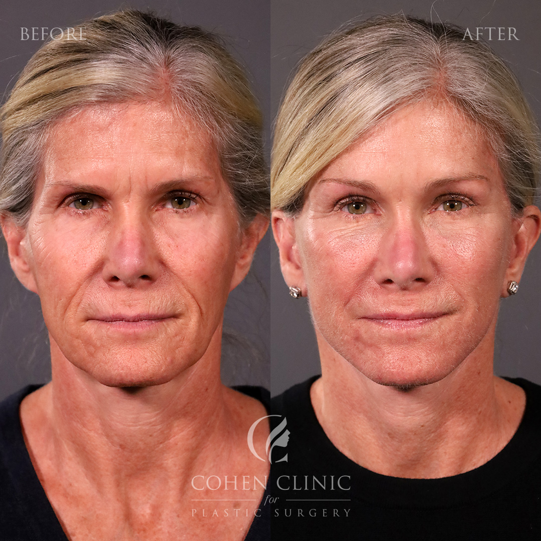 Case 98772 Marge Image