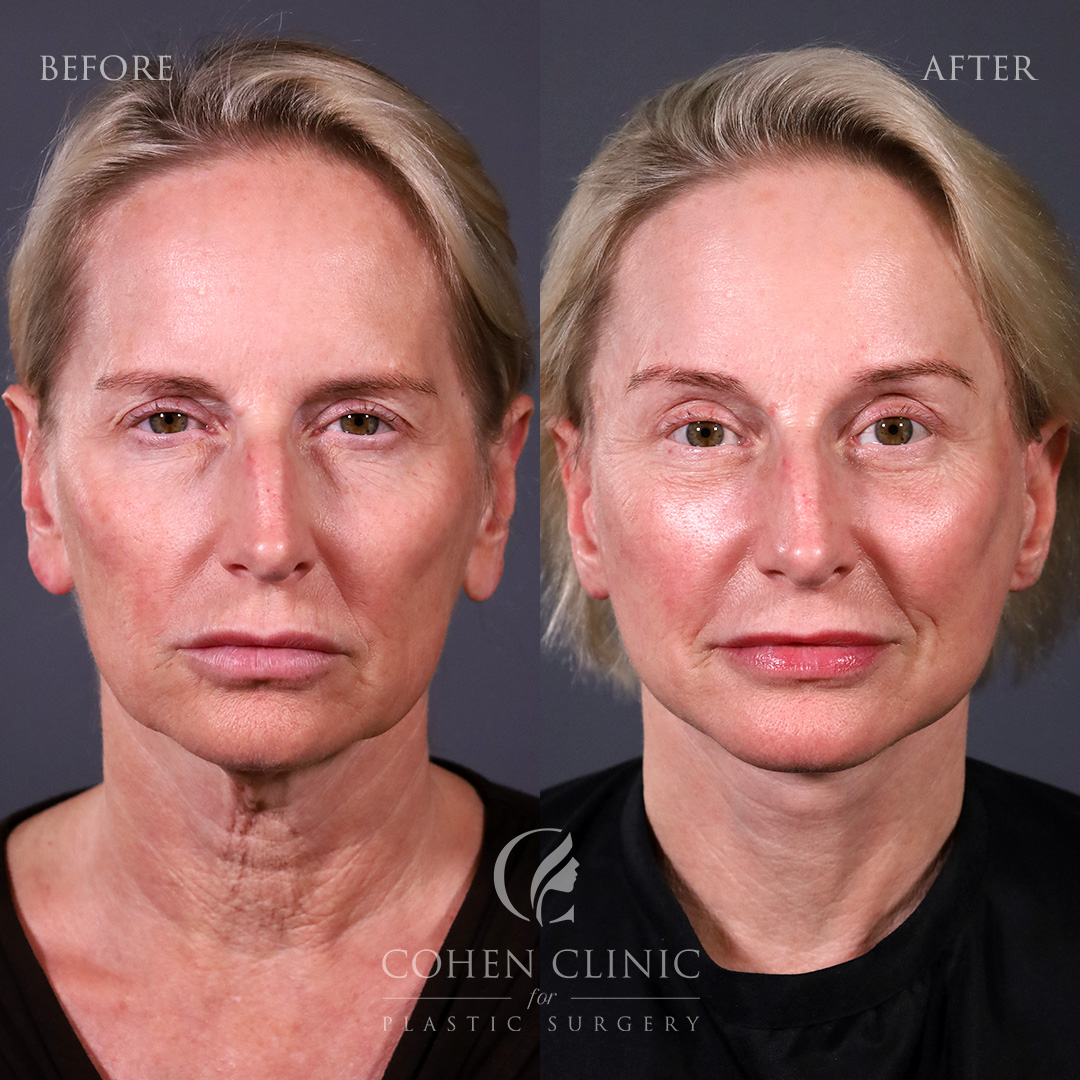 Case 35582 Marge Image