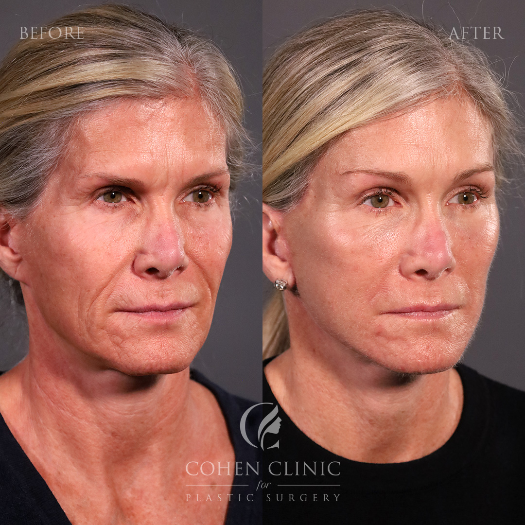 Case 98772 Marge Image