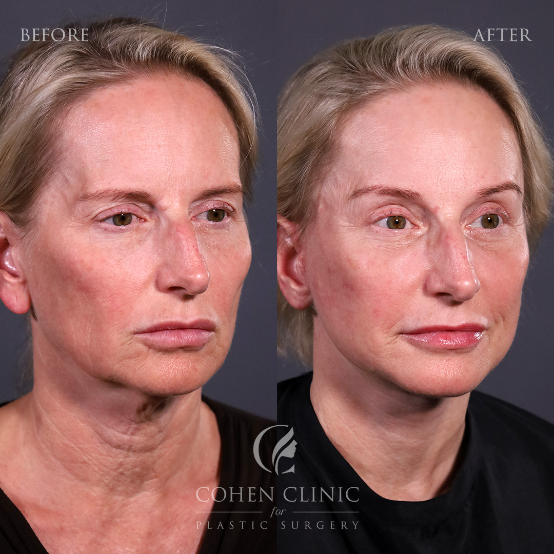 Case 35582 Marge Image
