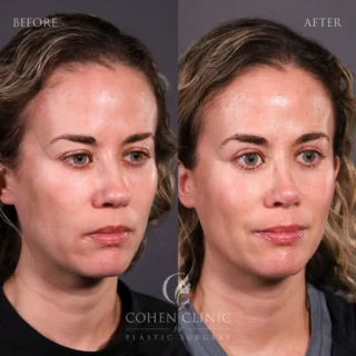 lip lift washington d.c. 🥇 Washington DC Lip Lift Before and After Pictures main image 0